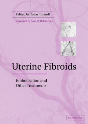 Uterine Fibroids <span>  </span>